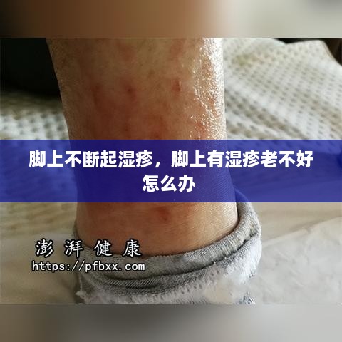 腳上不斷起濕疹，腳上有濕疹老不好怎么辦 