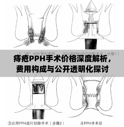 痔瘡PPH手術(shù)價(jià)格深度解析，費(fèi)用構(gòu)成與公開透明化探討