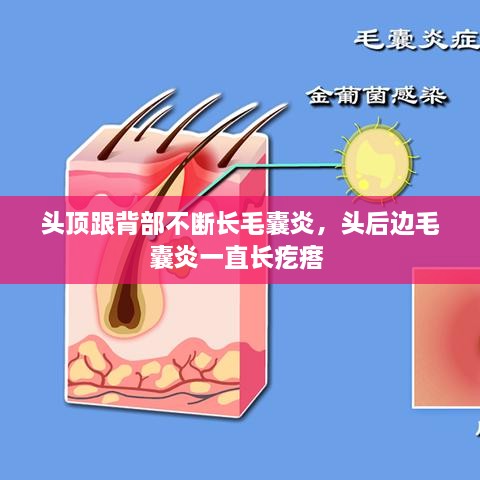 頭頂跟背部不斷長毛囊炎，頭后邊毛囊炎一直長疙瘩 