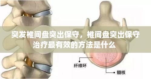 突發(fā)椎間盤突出保守，椎間盤突出保守治療最有效的方法是什么 